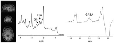 Multimodal Neuroimaging Study of Visual Plasticity in Schizophrenia